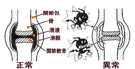 関節の痛みの原因